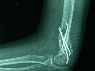 titanium wire in Orthopedic Implants and Repair Systems